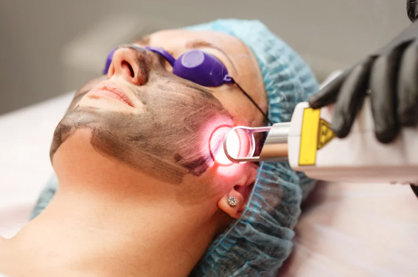 hollywood peeling en que consiste